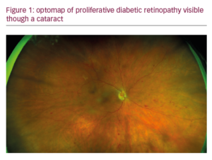 The Role Of Ultra-widefield Retinal Imaging As A Standard Assessment ...