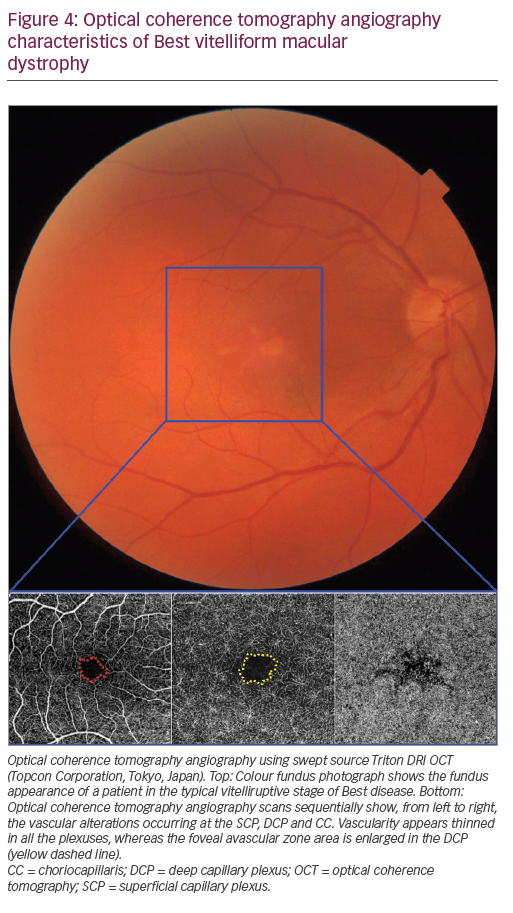Retinal vascular assessment in psoriatic patients with and without  metabolic syndrome using optical coherence tomography angiography