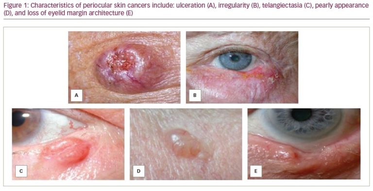 Clinical Features And Management Of Eyelid Malignancies ...