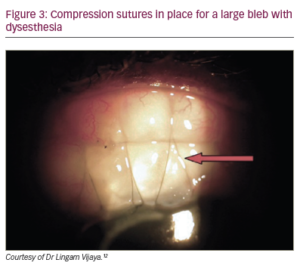 Bleb Management Following Trabeculectomy And Glaucoma Drainage Device ...