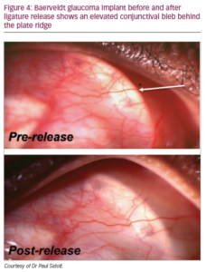 Bleb Management Following Trabeculectomy And Glaucoma Drainage Device ...