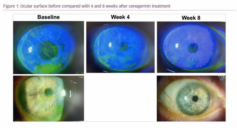 Neurotrophic Keratitis: Exploring the Therapeutic Landscape ...