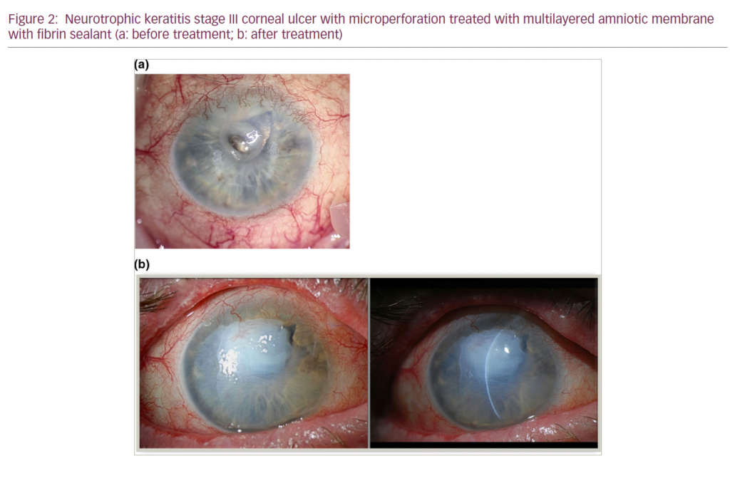 Neurotrophic Keratitis: Exploring the Therapeutic Landscape ...