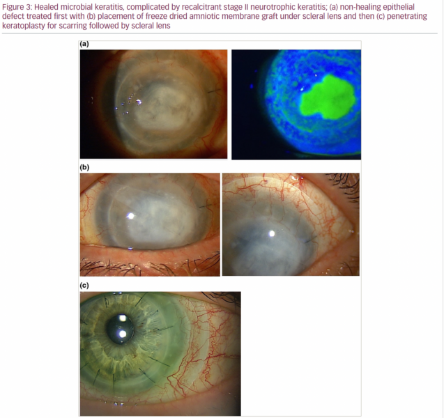 Neurotrophic Keratitis: Exploring the Therapeutic Landscape ...