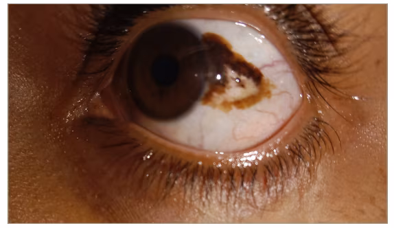Figure 3: Large, deep conjunctival nevus