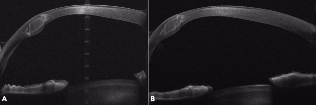 Figure 2: Corneal OCT of the implanted ECO-CAIRS segment at 1-month and 1-year post-implantation